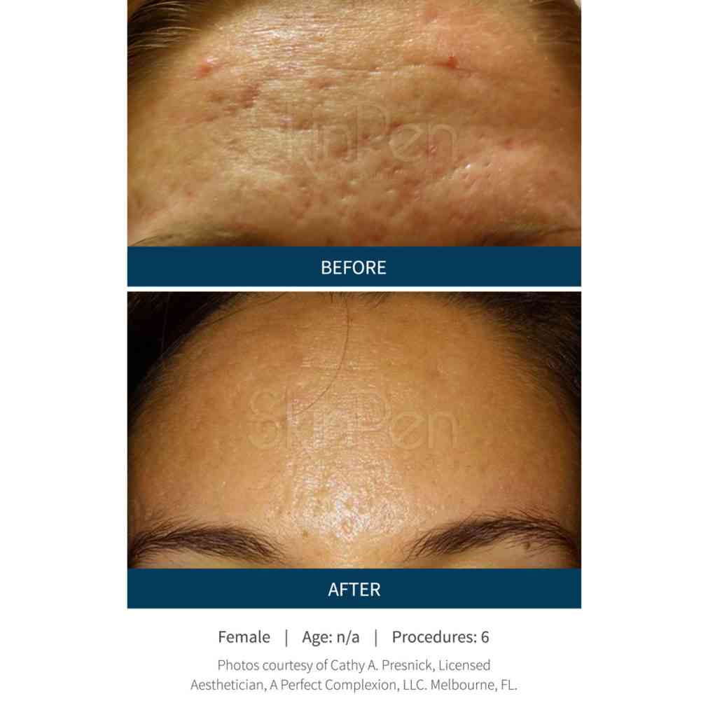 Microneedling 