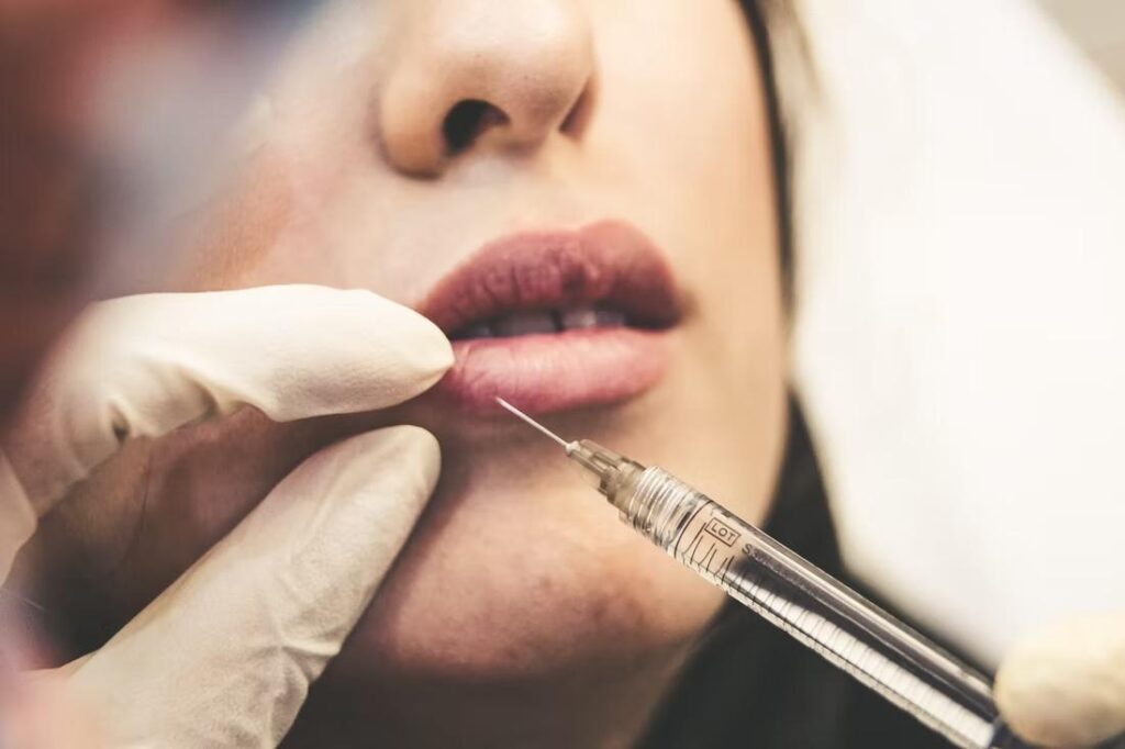 Dermal Filler For Lip Augmentation